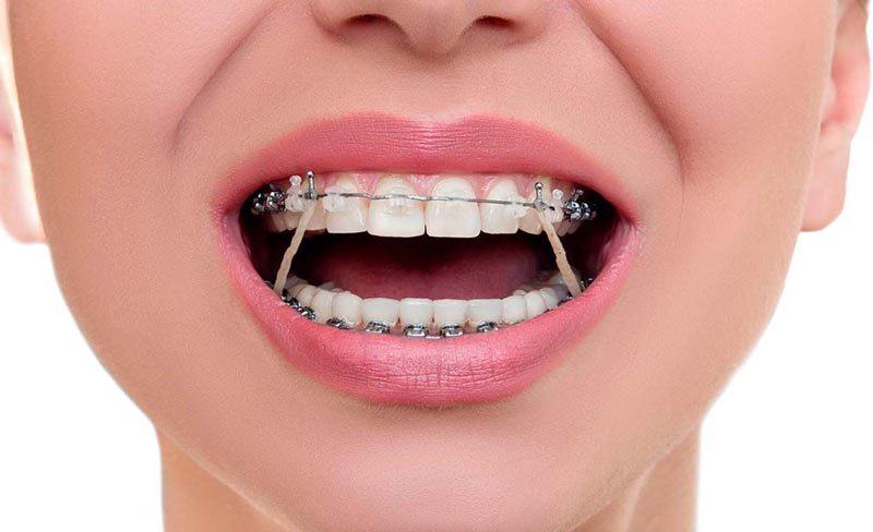 ارتودنسی دیمون چیست