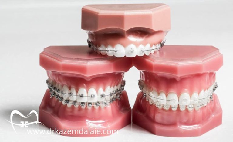 انواع ارتودنسی دندان