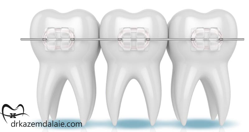 ارتودنسی سرامیکی چیست