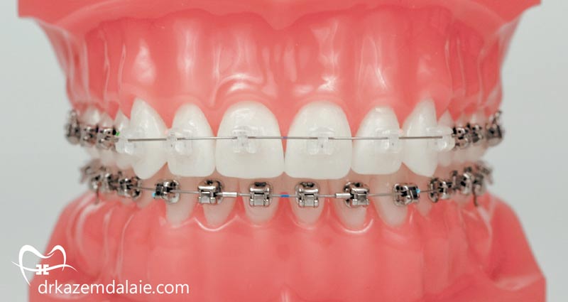 مزایا و معایب ارتودنسی سرامیکی دندان
