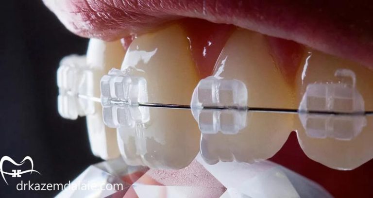 ارتودنسی سرامیکی در تهران