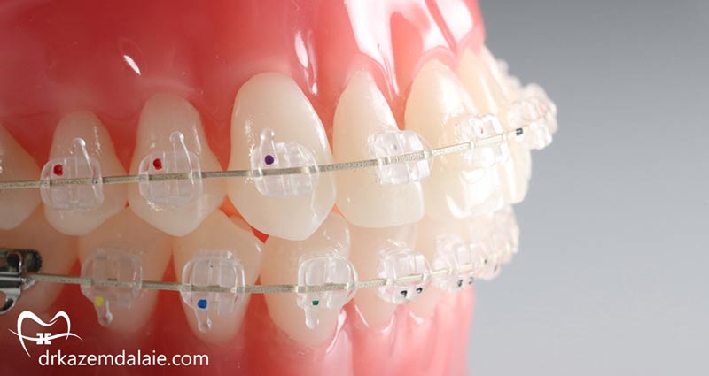هزینه ارتودنسی سرامیکی در تهران