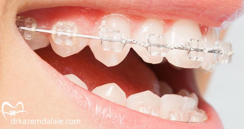 ارتودنسی سرامیکی دندان