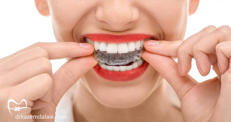 ارتودنسی کنیم یا کامپوزیت؟