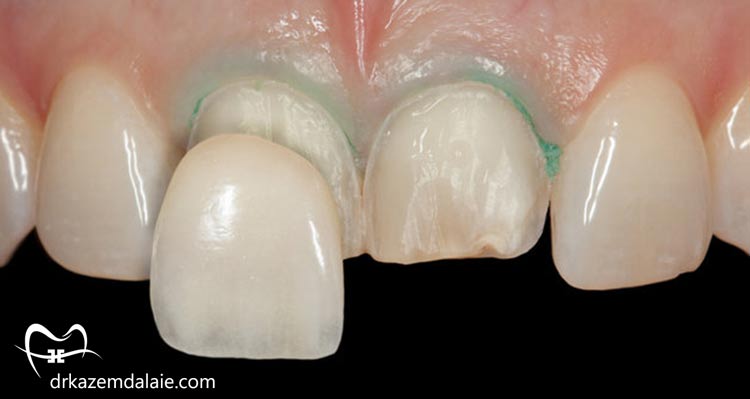 کامپوزیت یا ارتودنسی؟