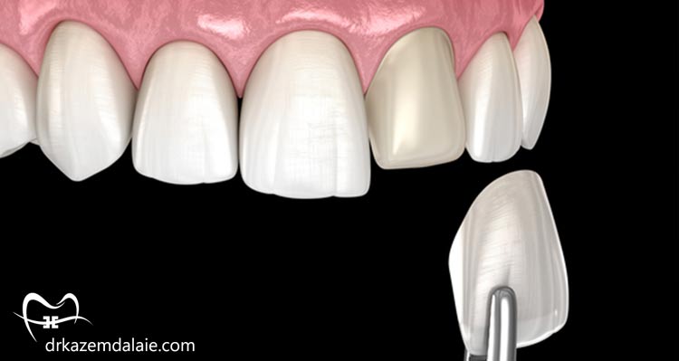 کامپوزیت یا ارتودنسی؟