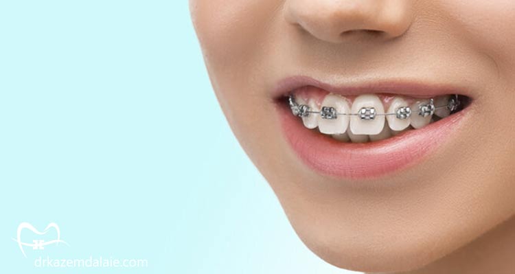 کامپوزیت یا ارتودنسی؟