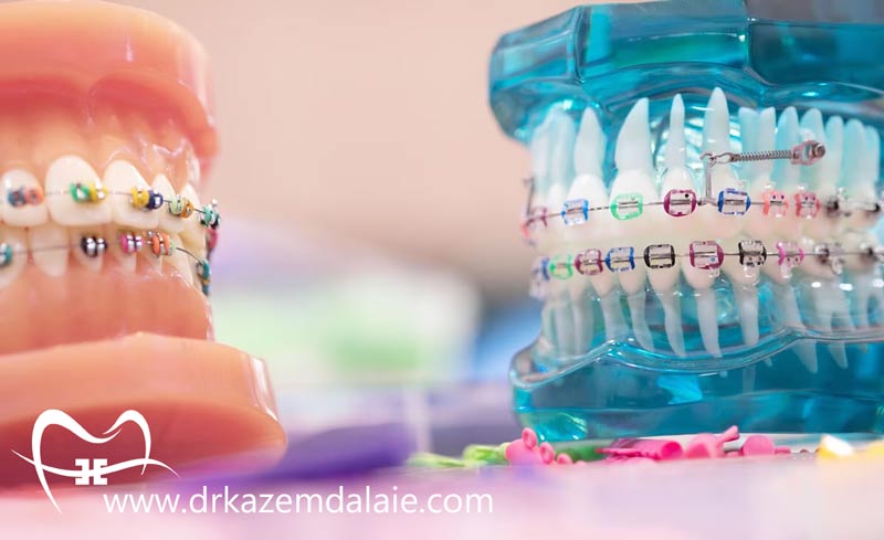 انواع ارتودنسی دندان