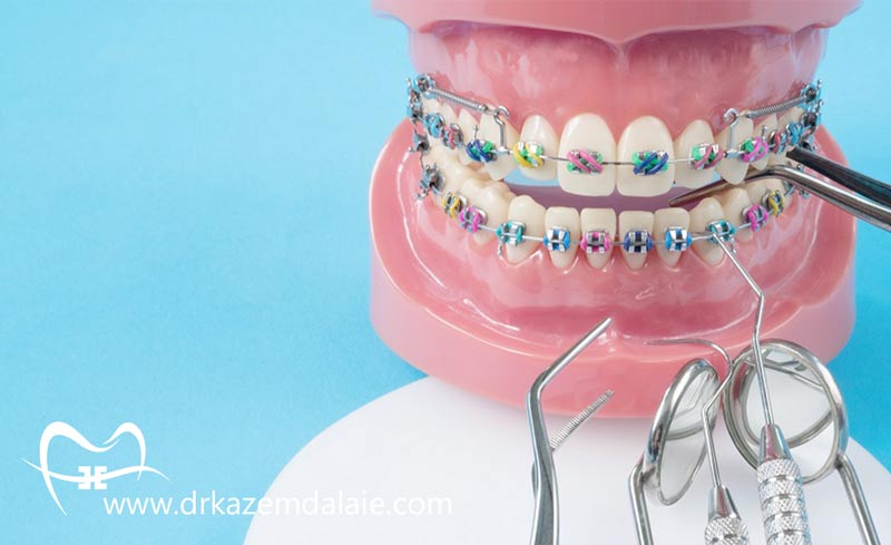 معرفی انواع ارتودنسی دندان