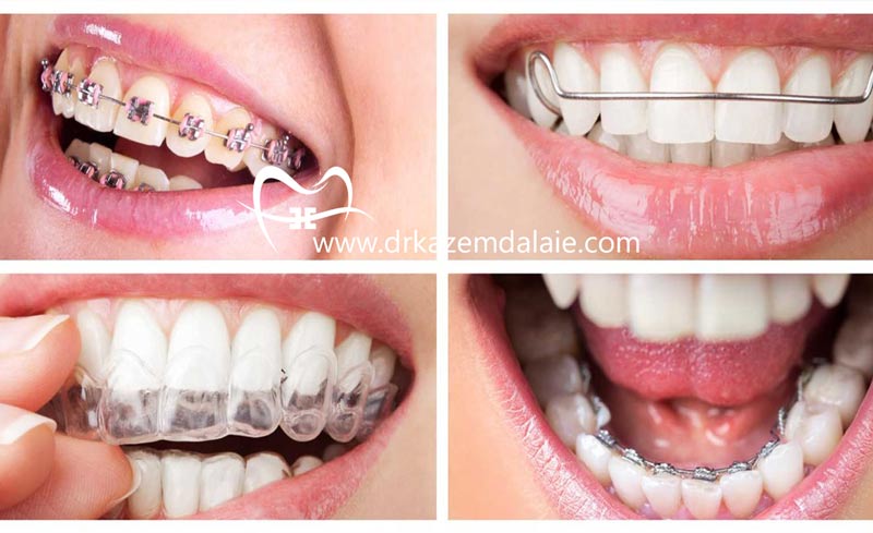 انواع ارتودنسی دندان