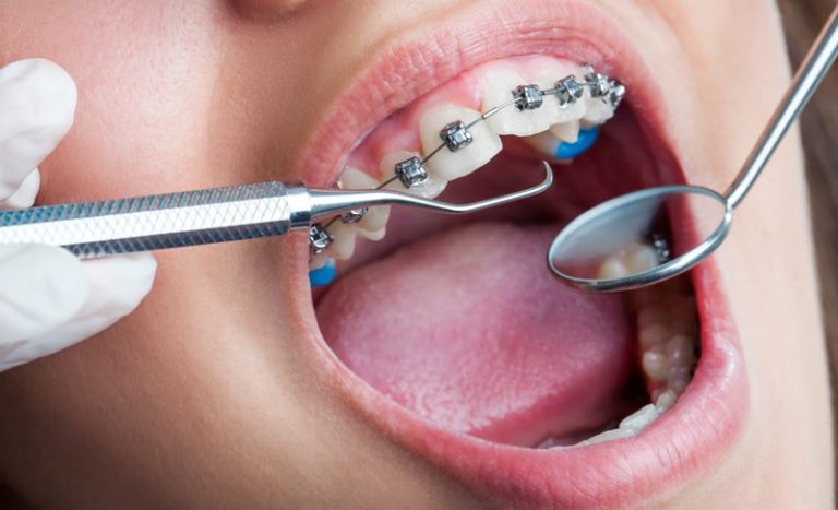 اقدامات قبل از ارتودنسی