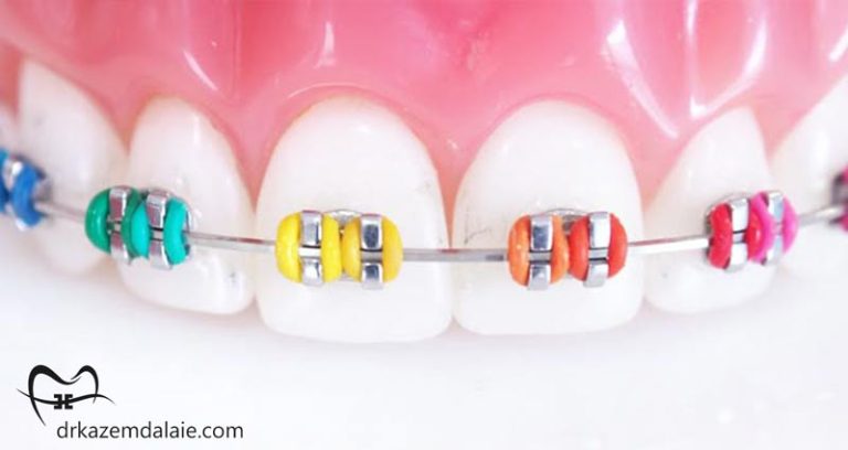 ارتودنسی رنگی