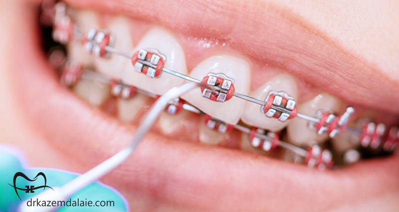 ارتودنسی رنگی دندان