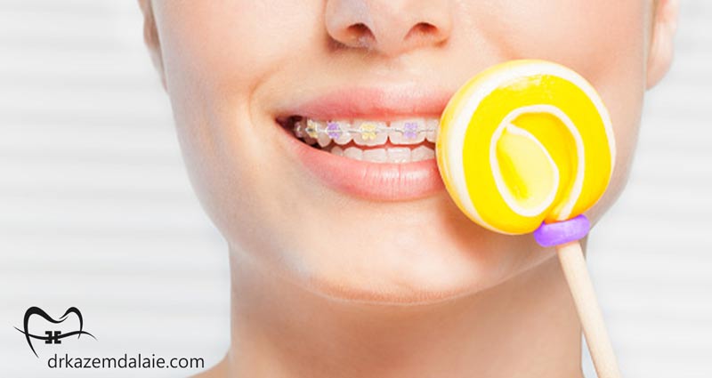 ارتودنسی رنگی دندان