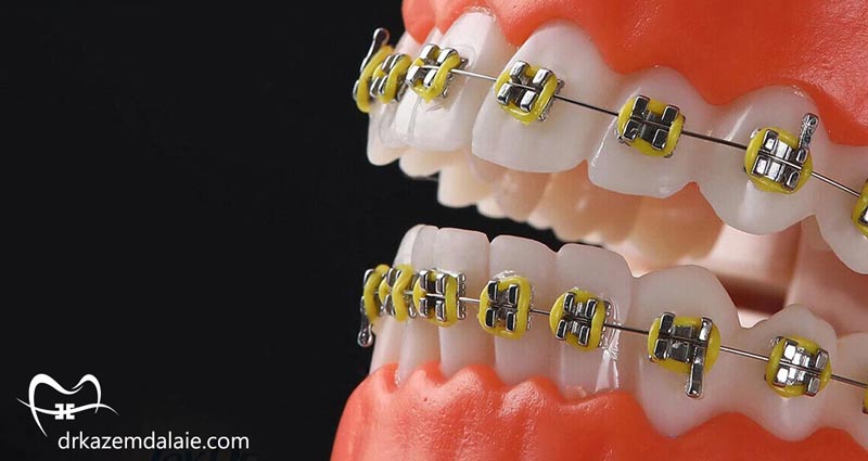 بهترین رنگ های ارتودنسی