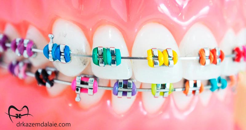 بهترین ترکیب رنگی ارتودنسی