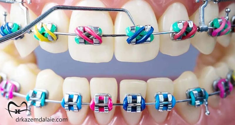 بهترین ترکیب رنگی ارتودنسی