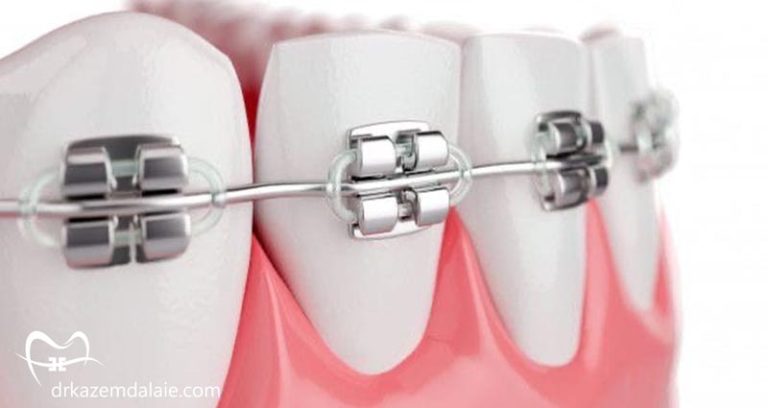 براکت های ارتودنسی