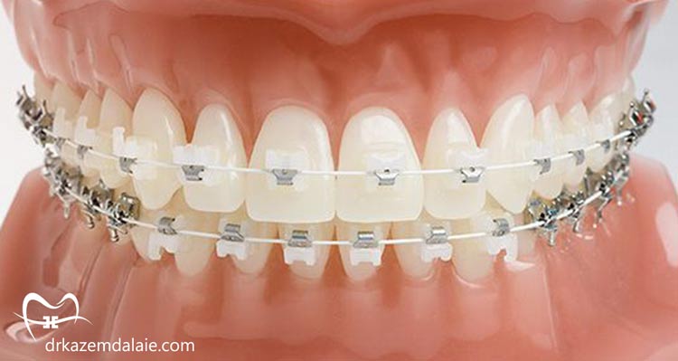 مزایای براکت ارتودنسی