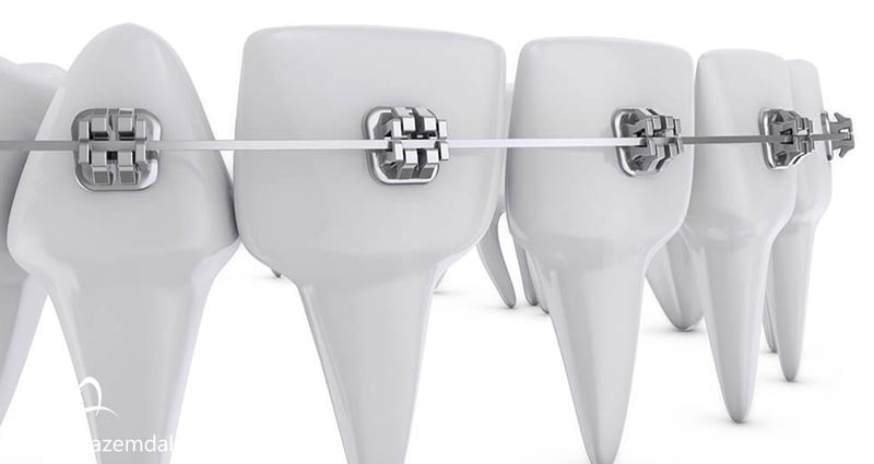 انواع براکت ارتودنسی