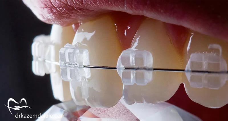 انواع براکت ارتودنسی