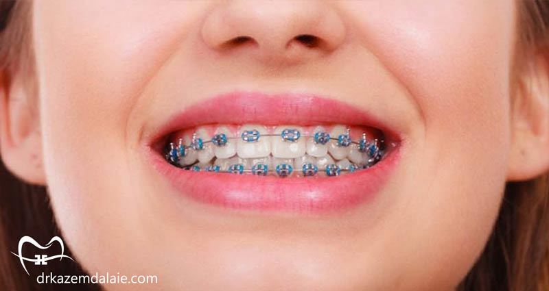 هزینه براکت ارتودنسی