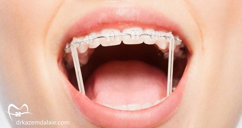 انواع کش و الاستیک ارتودنسی