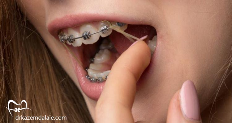 کش و الاستیک ارتودنسی