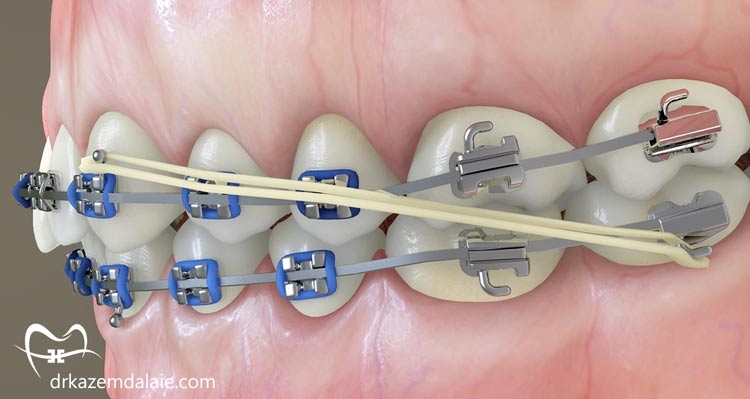 کش ارتودنسی