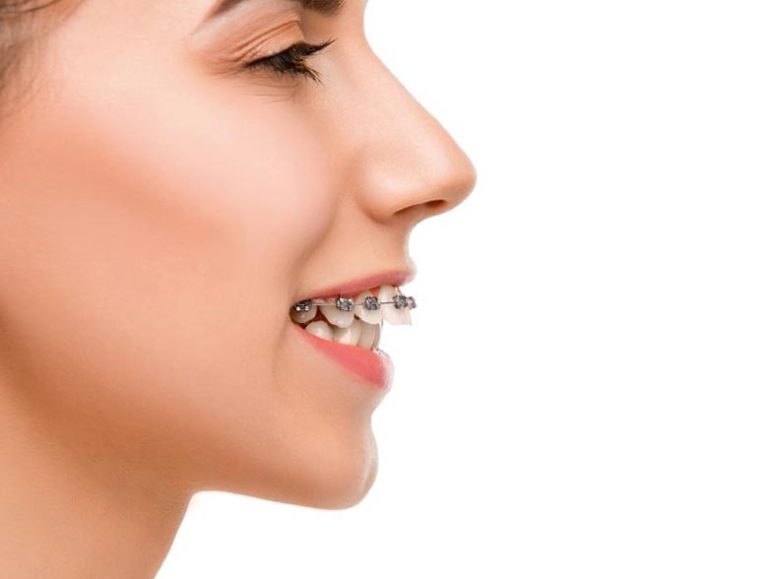 ارتودنسی فک بالا