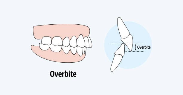 ارتودنسی فک بالا