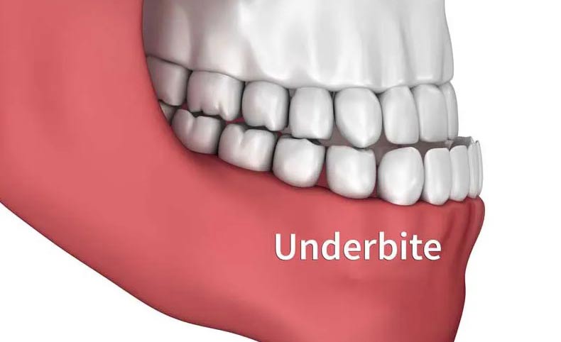 ارتودنسی فک پایین