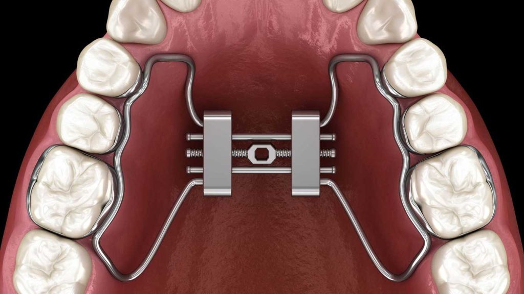 وسیع کننده کام یا پالاتال اکسپندر