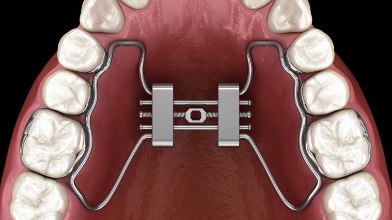 وسیع کننده کام یا پالاتال اکسپندر