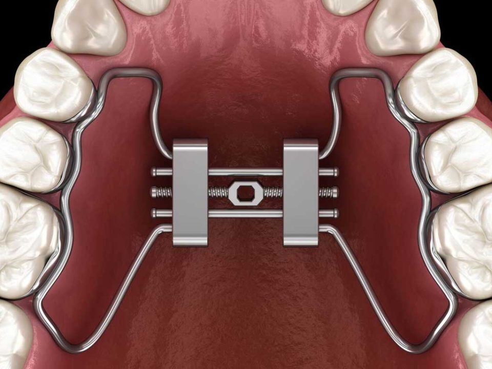 وسیع کننده کام یا پالاتال اکسپندر