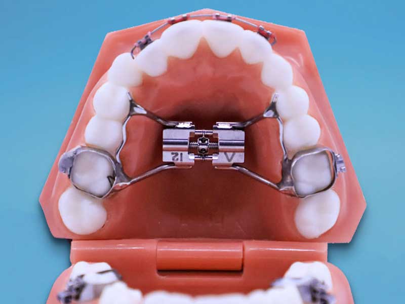 وسیع کننده کام یا پالاتال اکسپندر