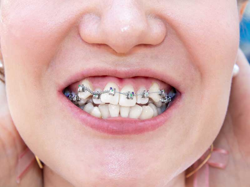 شلوغی دندان‌ ها