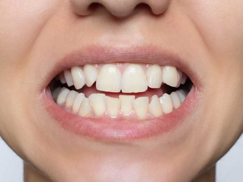 شلوغی دندان‌ ها