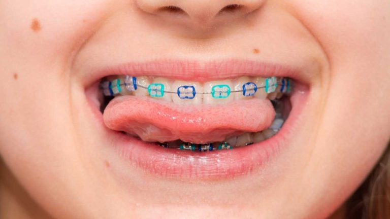 ارتودنسی دندان های شیری