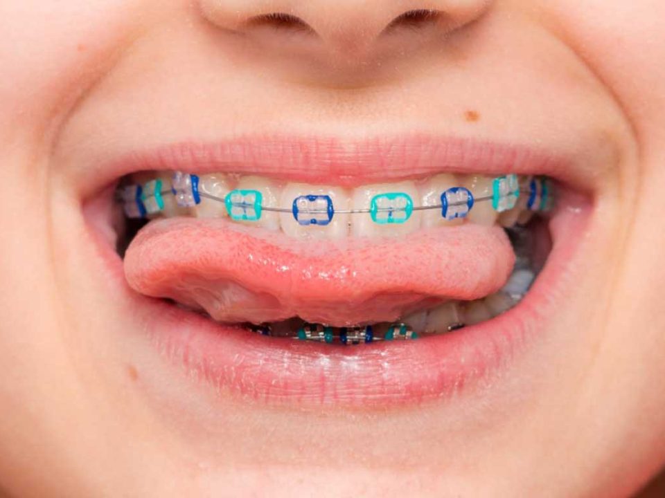 ارتودنسی دندان های شیری