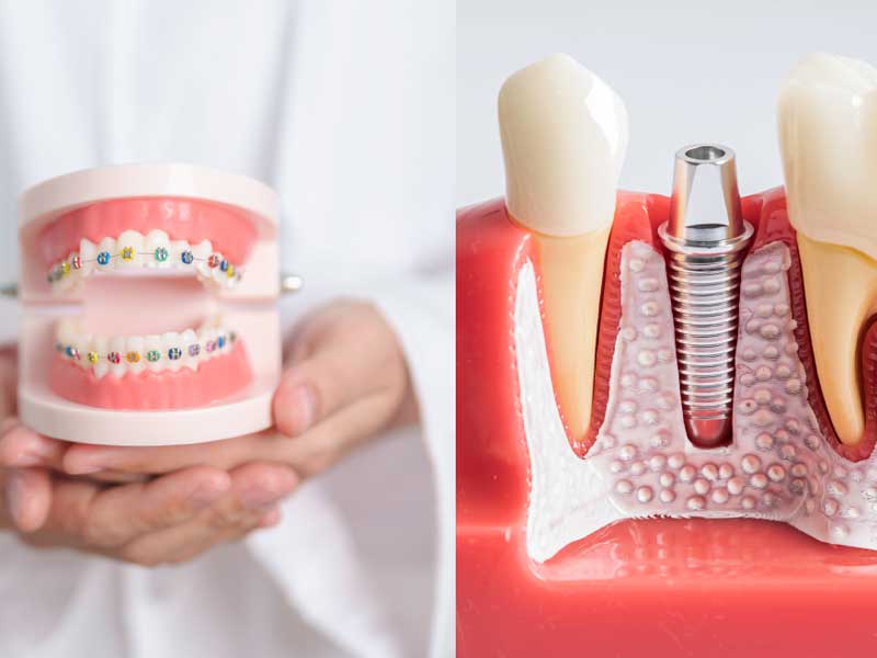ارتودنسی دندان‌ های ایمپلنت شده
