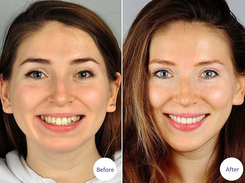 دلایل کشیدن دندان برای ارتودنسی