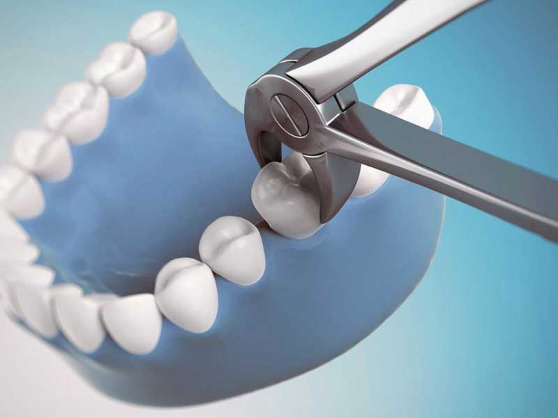 دلایل کشیدن دندان برای ارتودنسی