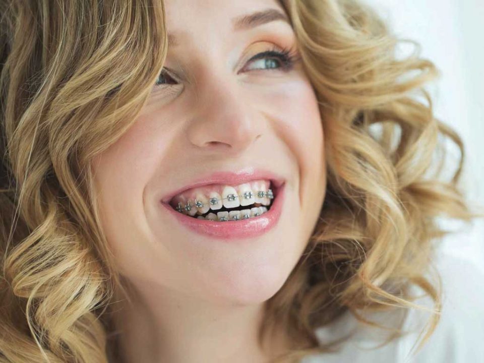 سن مناسب برای ارتودنسی بزرگسالان