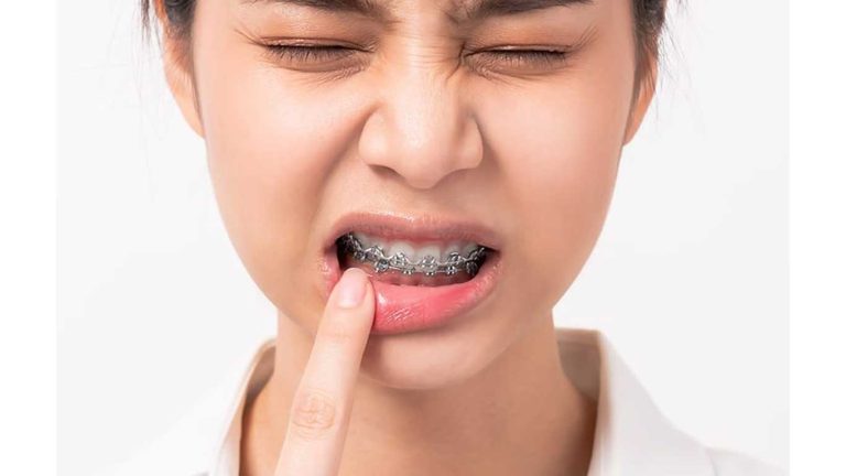 شکستن براکت و سیم ارتودنسی