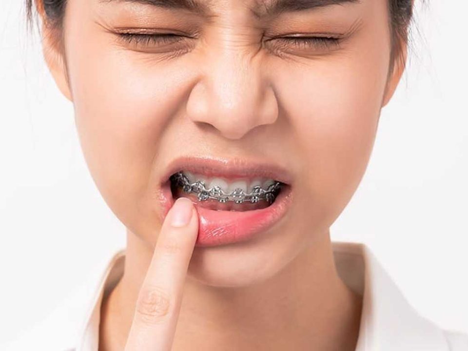 شکستن براکت و سیم ارتودنسی