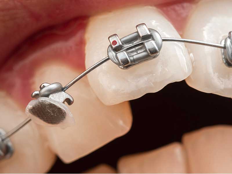 شکستن براکت و سیم ارتودنسی