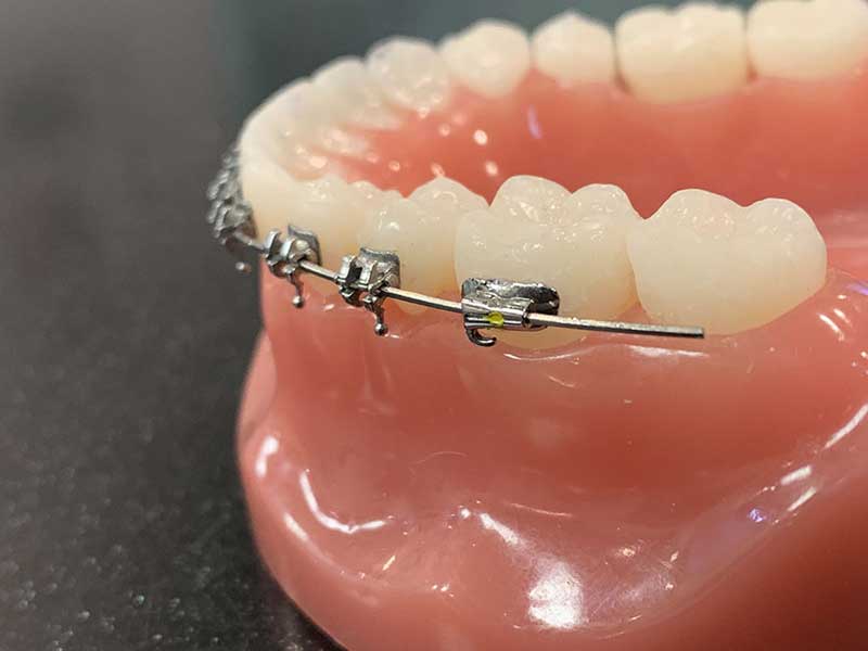 شکستن براکت و سیم ارتودنسی