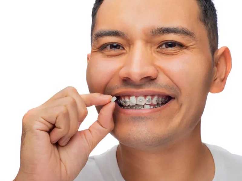 موم ارتودنسی چیست؟