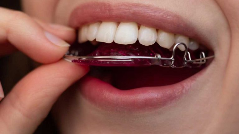 چرا باید بعد از ارتودنسی ریتینر گذاشت؟